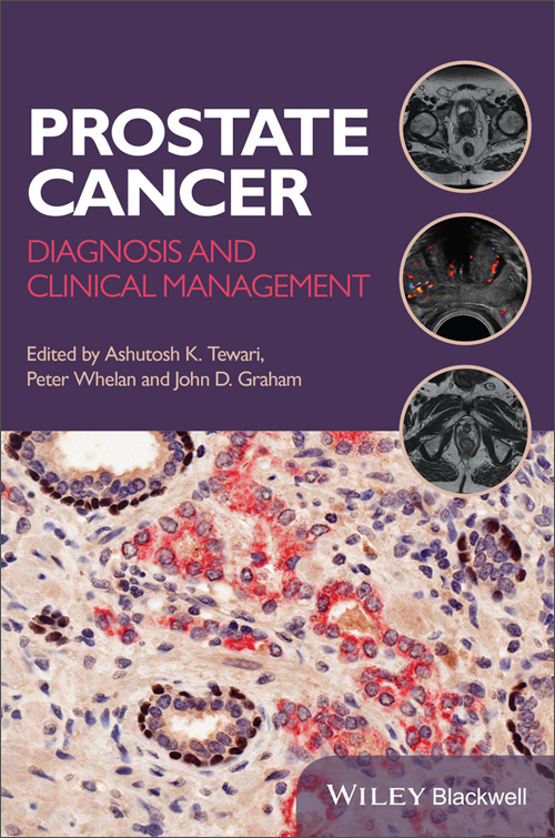 prostate cancer: diagnosis and clinical management
