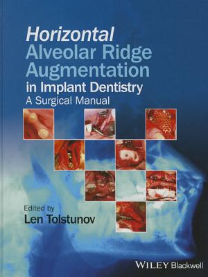 【预订】horizontal alveolar ridge augmentation