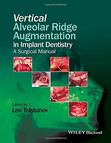 【预订】vertical alveolar ridge augmentation in
