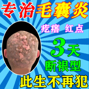 岩井昃弘毛囊炎洗发水头皮屑治疗 去屑药医用洗剂头部去屑止痒特有用 一盒药膏【当晚看效果】不吹牛