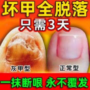 豫宁美灰指甲在效药根i治正i品 亮i甲灰指甲专用膏药指甲真菌感染脱甲 涂剂*3严重空甲·嵌甲】98%选择