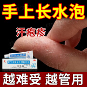 汗疱疹药膏 手上痒手指起小水泡用膏手指很痒长小疙瘩发痒水泡脱皮 杀菌止痒药膏 复方倍氯米松樟脑乳膏 1支【手上长小水泡】