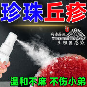 珍珠疹去除药品男性冠状沟珍珠疹珍珠粒疹丘疹专用膏药龟私处头瘙痒白垢 单盒装