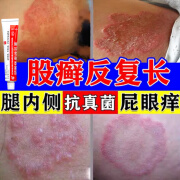 股藓专用药膏 股藓大腿内侧潮湿瘙痒股藓真菌感染止痒抑菌皮肤瘙痒皮炎湿疹抗真菌皮肤用药硝酸咪康唑乳膏 2盒【股癣真菌感染脱屑瘙痒】