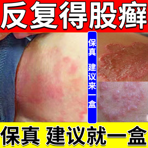 大腿根内测潮湿瘙痒 股癣用药膏发红潮湿闷热出汗瘙痒 克霉唑软膏抗真菌药皮肤用药 2盒