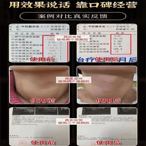 觅食天下夏枯草蒲公英散结茶消除甲状腺乳腺结节淋巴肺结节茶猫爪草散结汤 20包*1袋 【夏枯草蒲公英郁金猫爪草】5副 图片 4